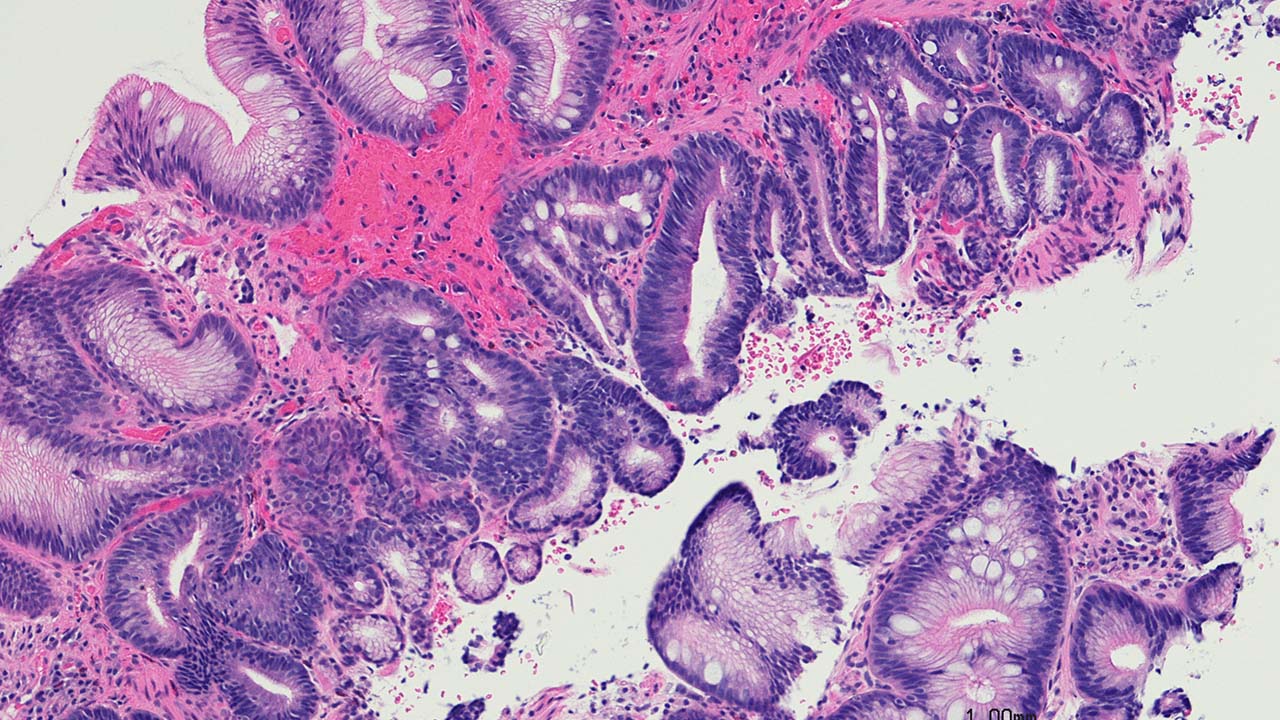 barretts oesophagus summary.jpg