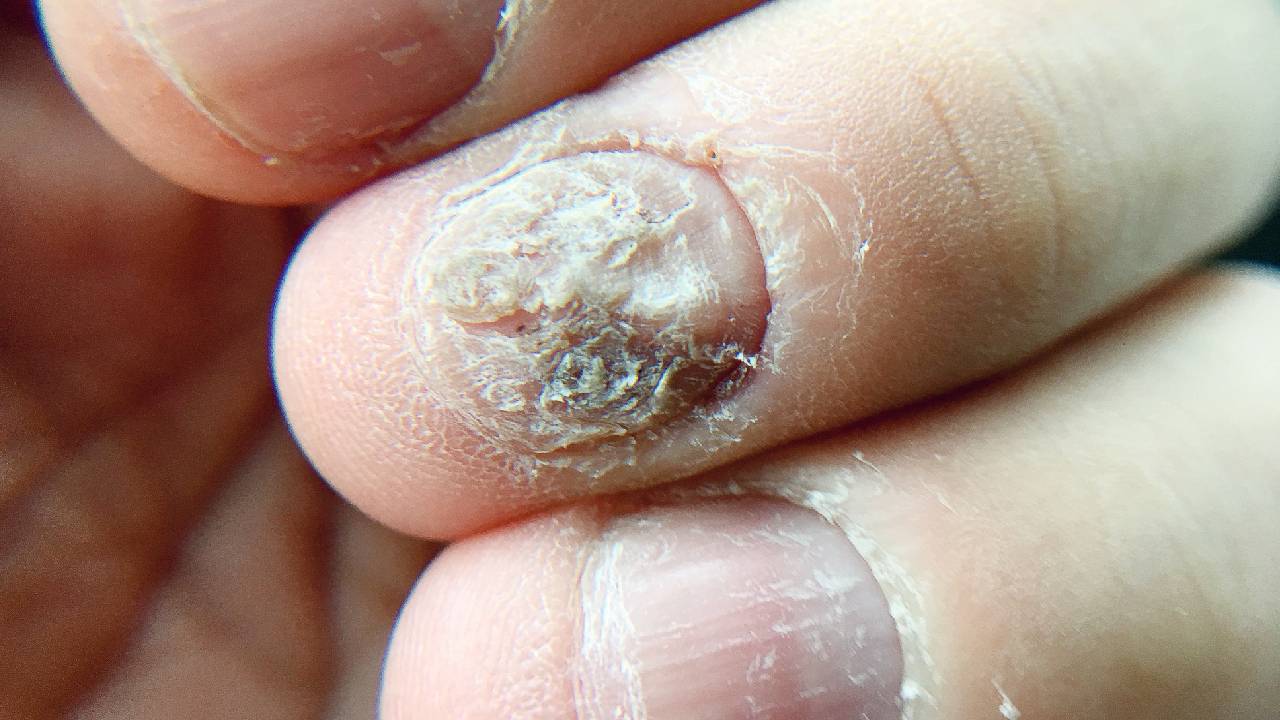 Natural Nail Fungus Treatment & Remedy for Your Symptoms