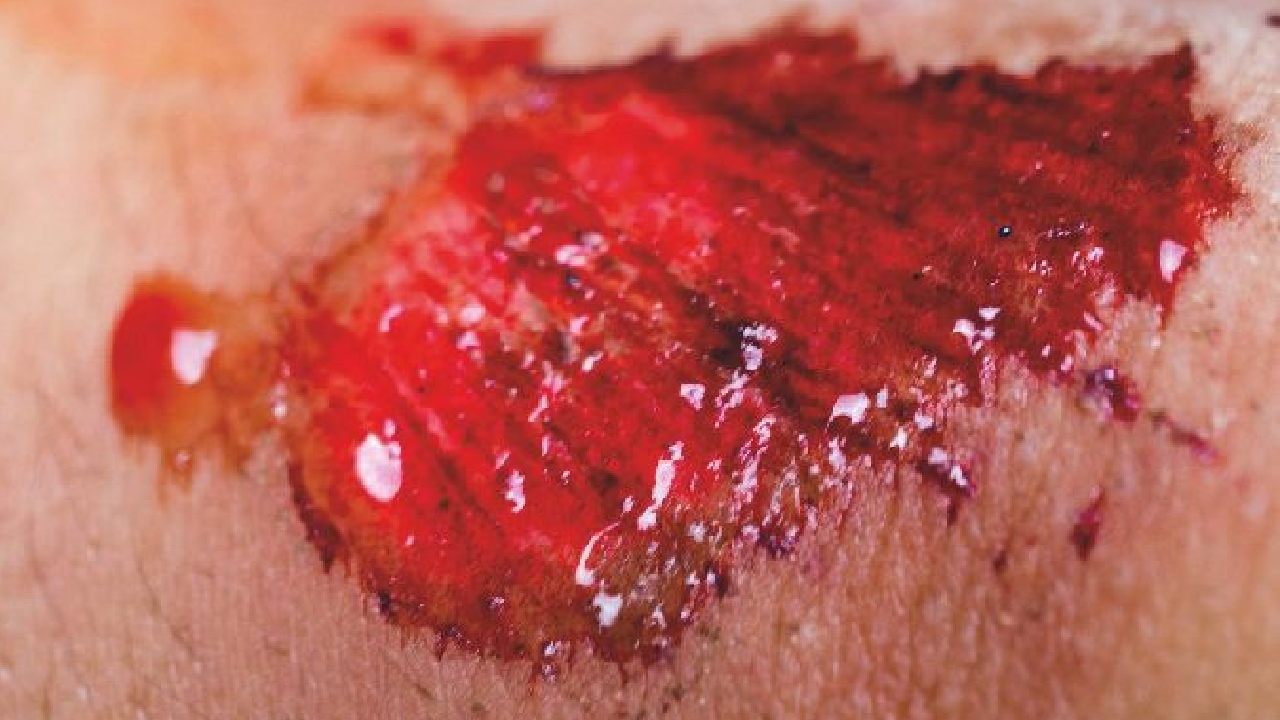 wound-summary