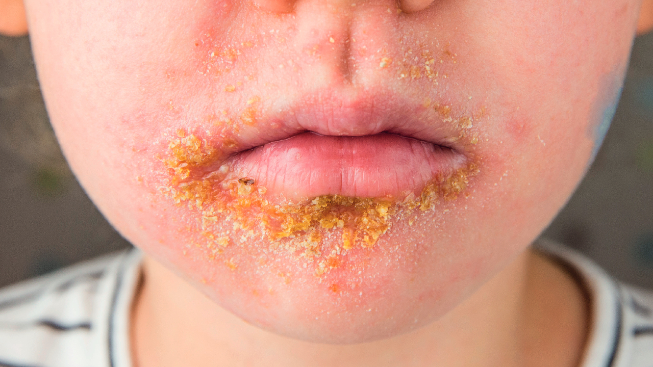 impetigo-child-summary