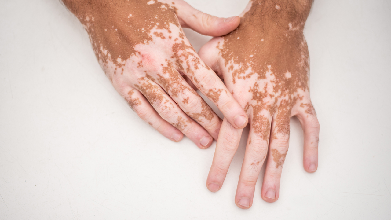 vitiligo