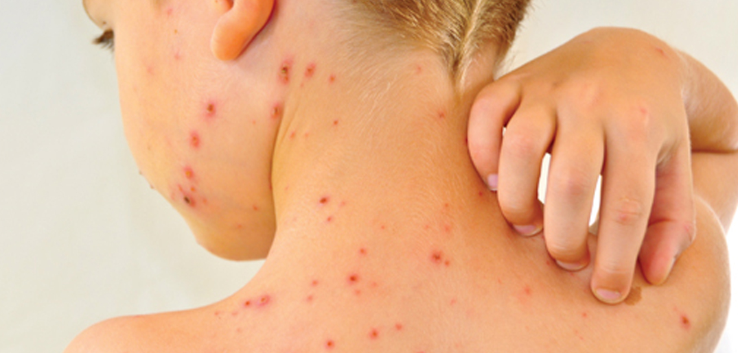 boy chicken pox_s.jpg