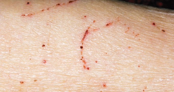 Pinworm dermatitis. A srácnak szemölcsök vannak