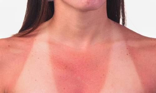 female-sunburnt-main