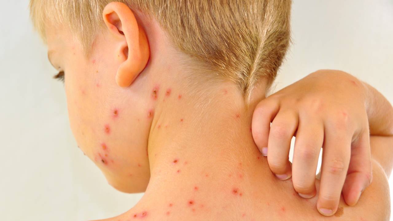 child-rash-chicken-pox-scarlet-fever-summary