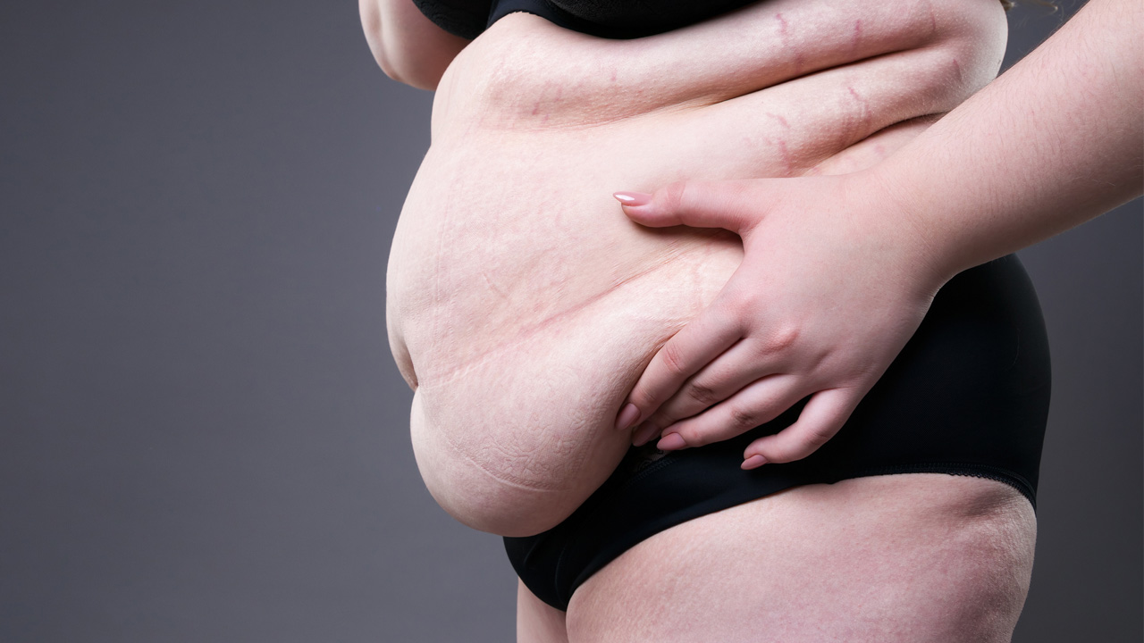 obesity-female-copy