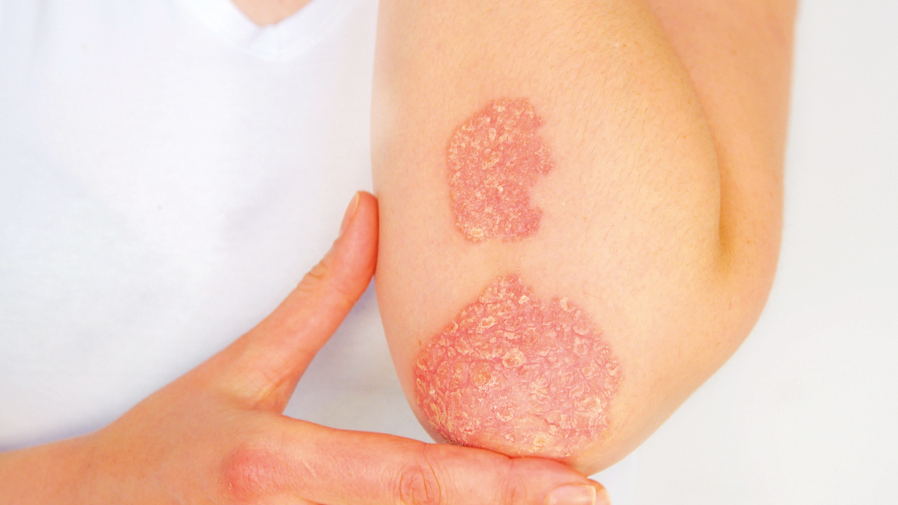psoriasis-femalearm