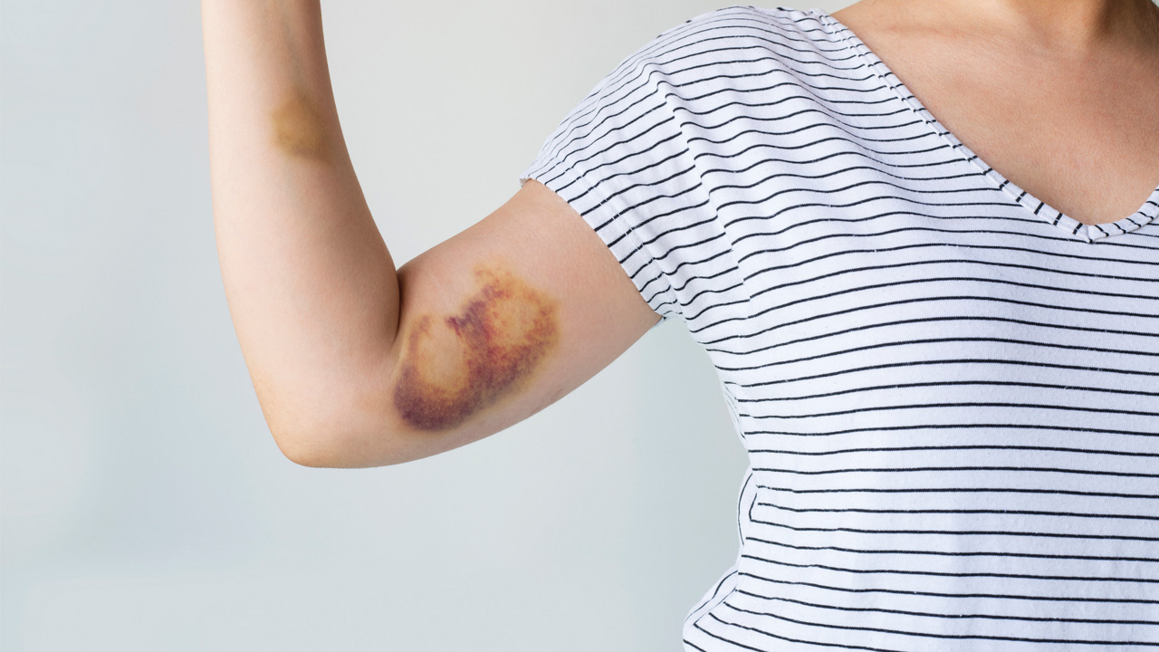 bruise-main