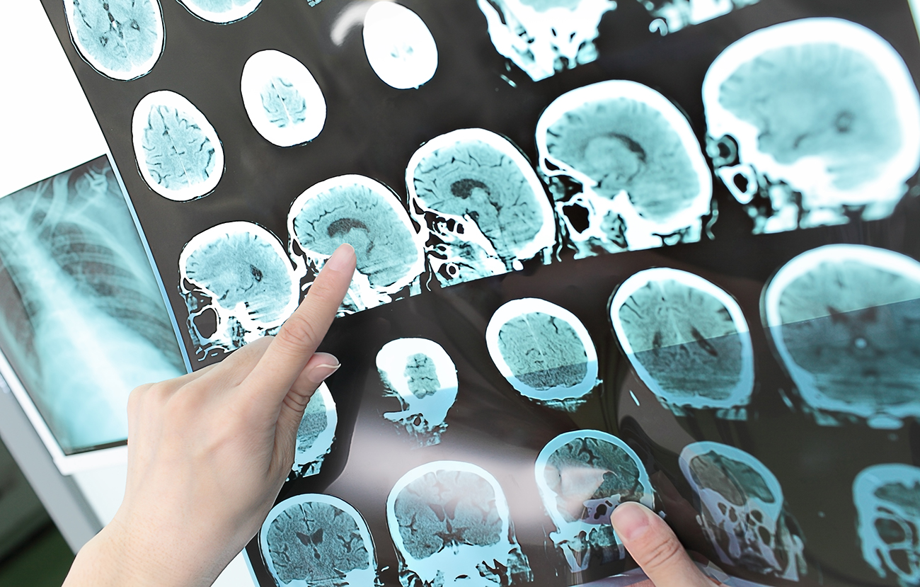 brain_MS_multiple_sclerosis_scan.jpg