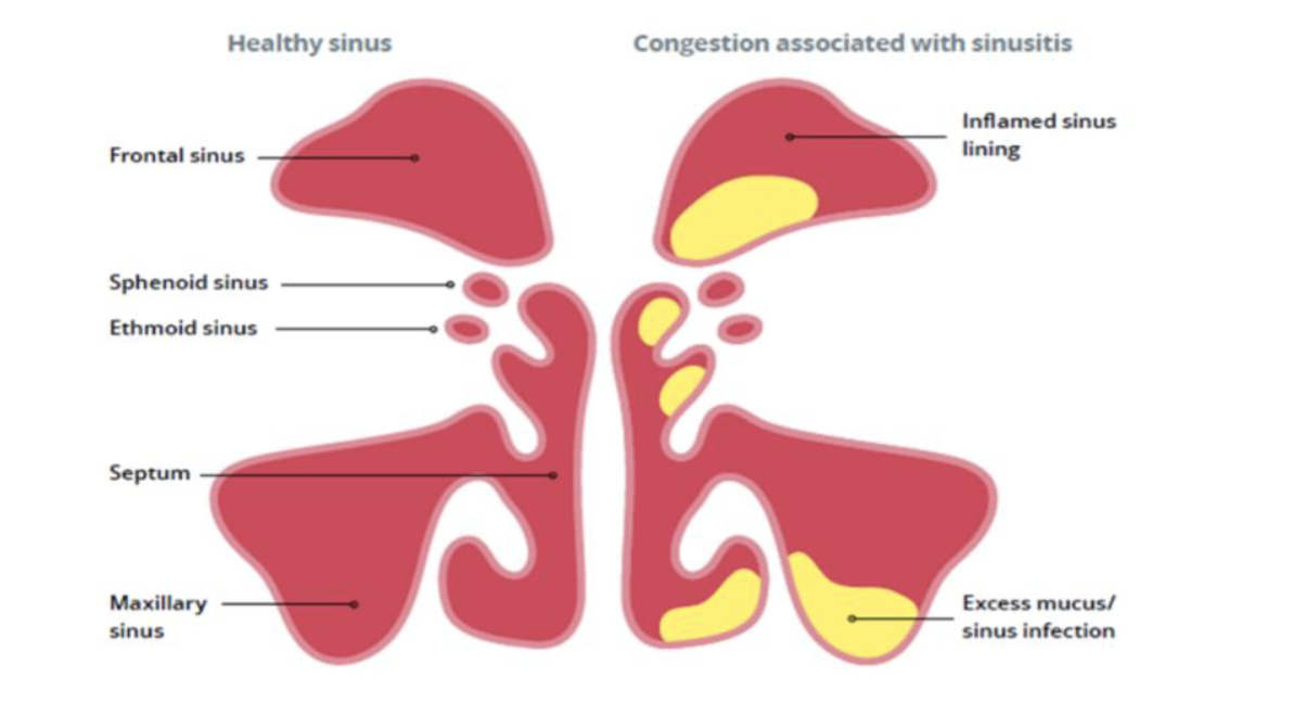Sinusitis nhs hotsell